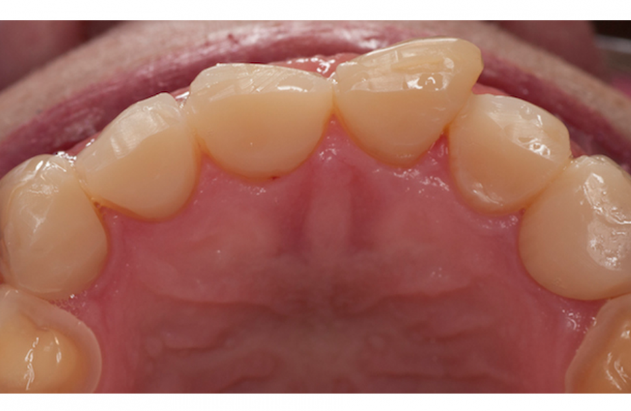 <p><strong>Image 3</strong> Après la restauration palatine des dents 13 à 23</p>