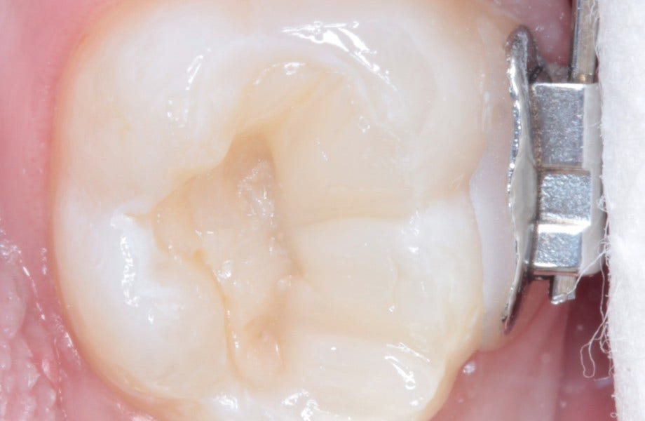 <p><strong>Image 4 </strong>Première partie du plan occlusal avec A2E</p>