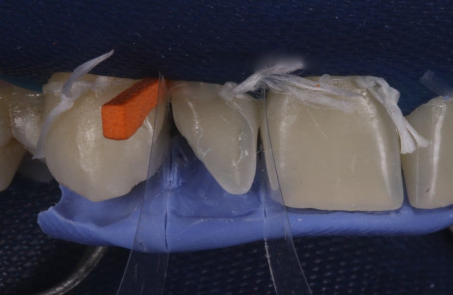 <p><strong>Image 4</strong> Clé en silicone in situ</p>