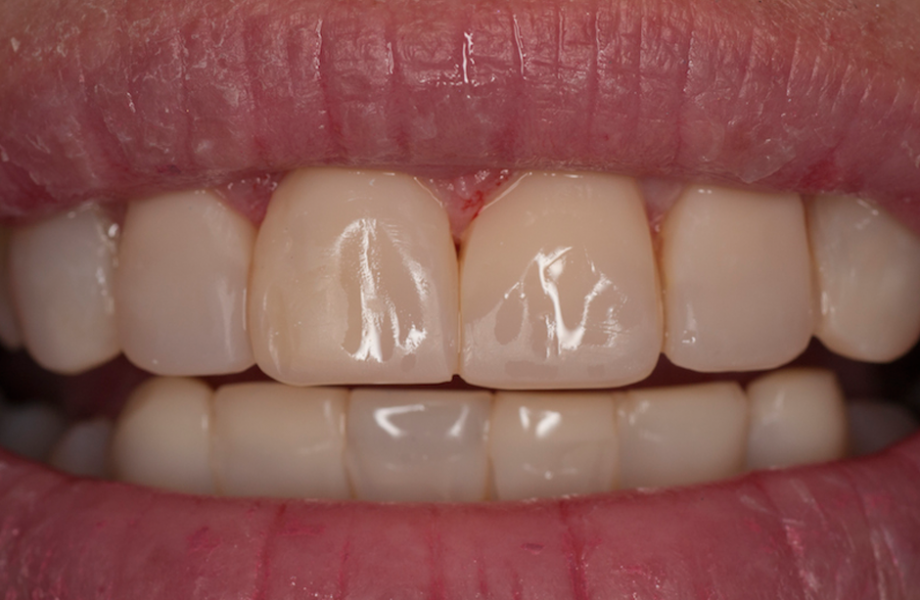 <p><strong>Image 4</strong> Résultat final: les dents ont été restaurées et plaquées avec la combinaison de teintes A2D et A2E, CLEARFIL MAJESTY ™ ES-2 PREMIUM</p>