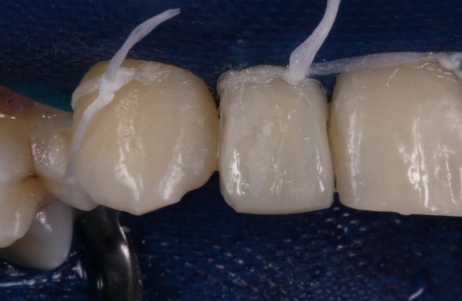 <p><strong>Image 6 </strong>Restauration à l'aide de A2D et A2E. A3.5D dans la zone cervicale</p>