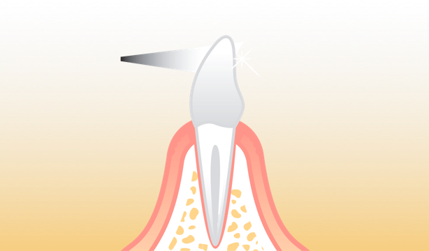 Natural tooth