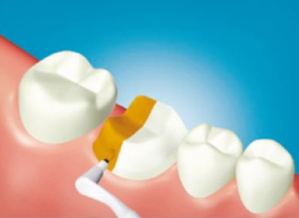 3. Mescolare quantità uguali di ED PRIMER II A + B e applicare sul dente. Attendere per 30 secondi.