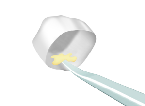 7. Applicare la miscela di pasta alla corona sabbiata e posizionare la corona.
