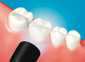 9a. Fotopolimerizzare i margini per 20 sec. per ogni superficie (lampada tradizionale alogena o LED) o per 5 sec. per ogni superficie (torcia al plasma o lampada alogena rapida).
