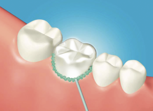 OPPURE 9b. Autoindurire il materiale mediante applicazione di OXYGUARD™ sui margini. Poi attendere per 3 min.