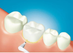 8. Rimuovere il cemento in eccesso. (Per una facile pulizia, fotopolimerizzare parzialmente il cemento in eccesso per 2–5 sec. con lampada tradizionale alogena o LED, poi rimuovere l'eccesso.)*