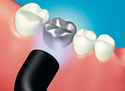 Cementación de coronas y puentes,<br>inlays y onlays de metal