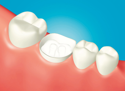 Cementazione di monconi endodontici<br>e perni prefabbricati