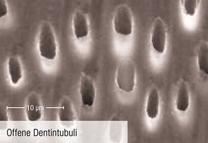 Offene Dentintubuli