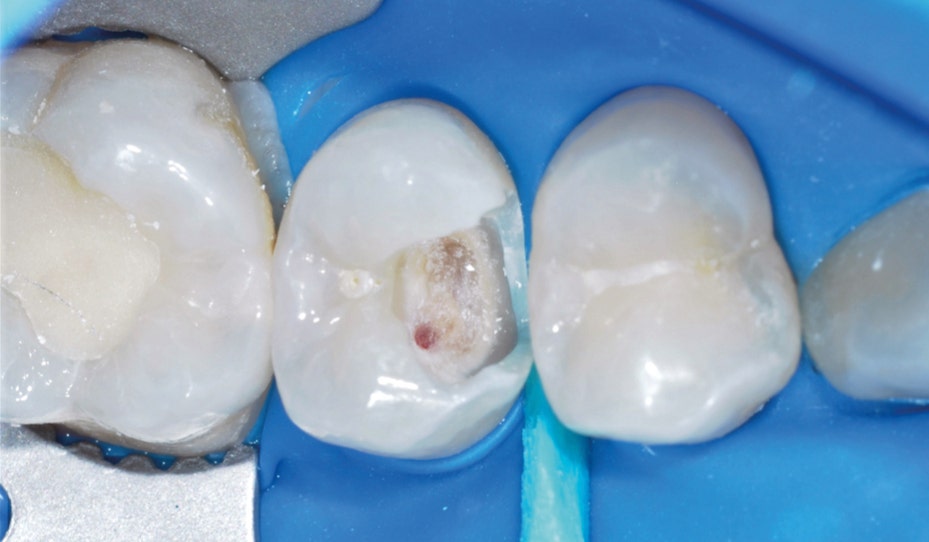 Clinical procedure for indirect pulp capping. (A) Rubber dam isolation