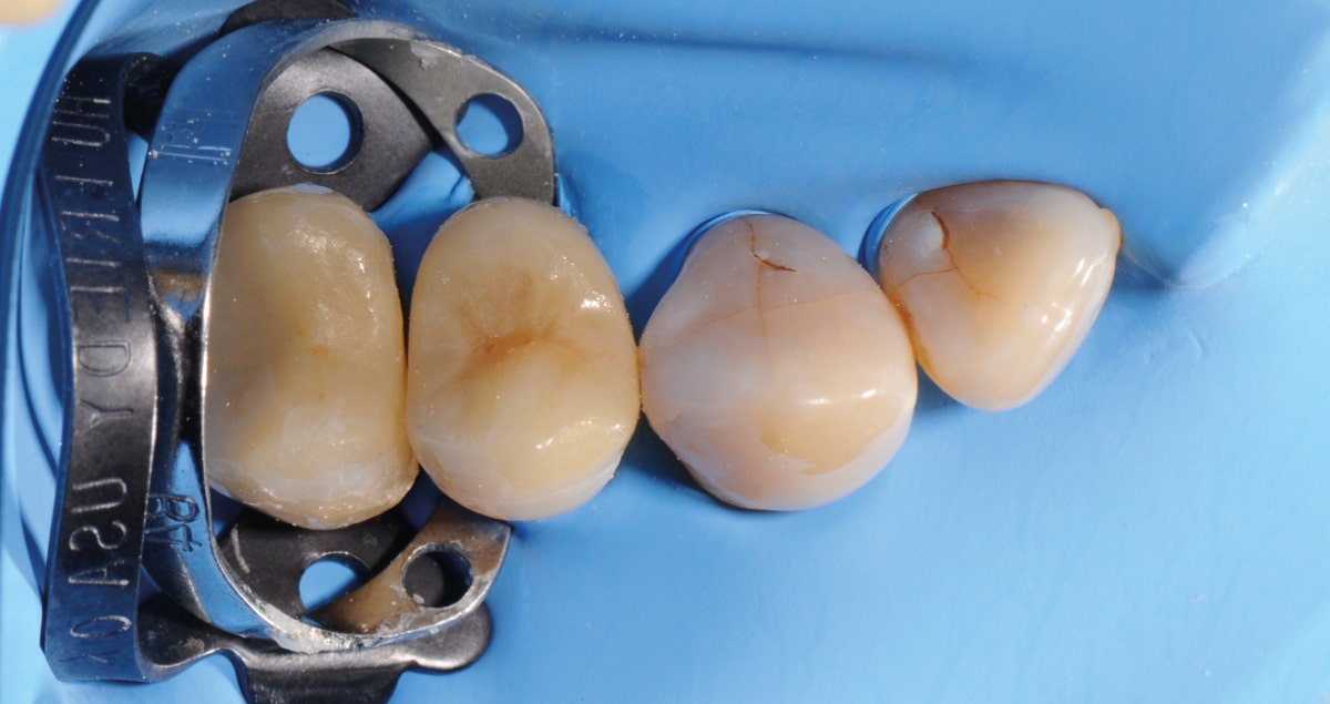 Deep margin elevation and placement of an onlay using warmed resin composite