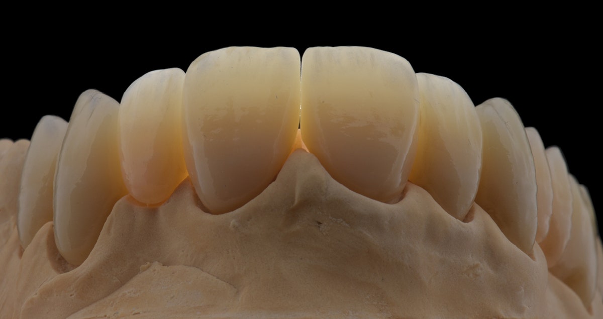 Restauraciones de KATANA Zirconia: pretratamiento para la cementación adhesiva
