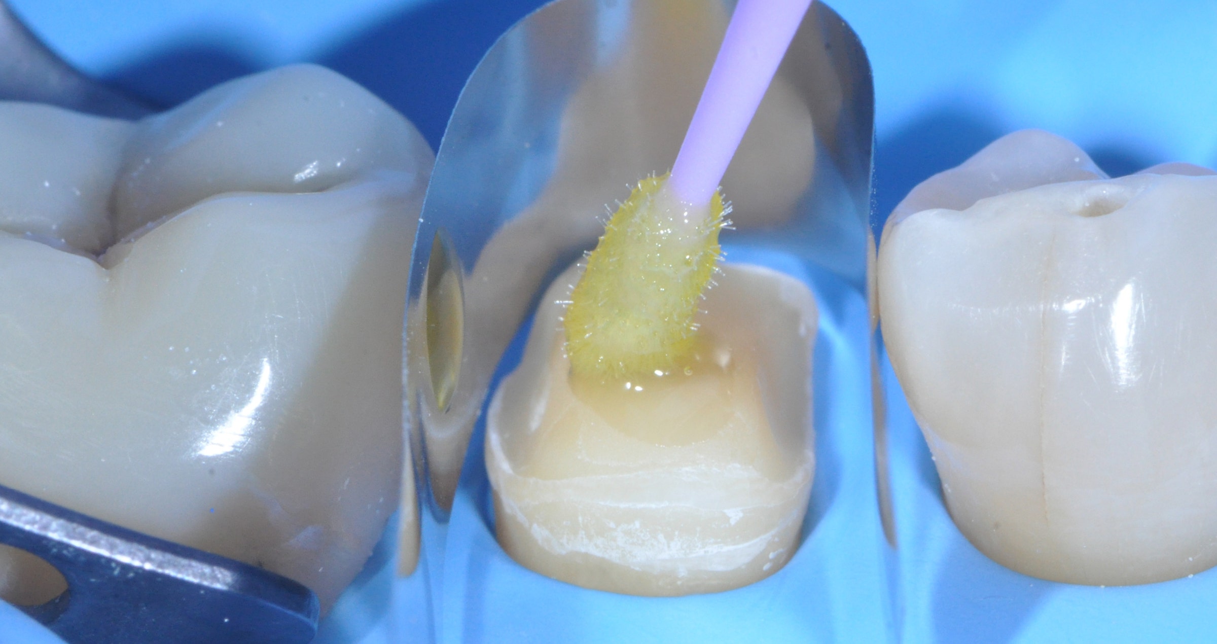 Amalgam replacement: Why and when hybrid ceramics are a great option
