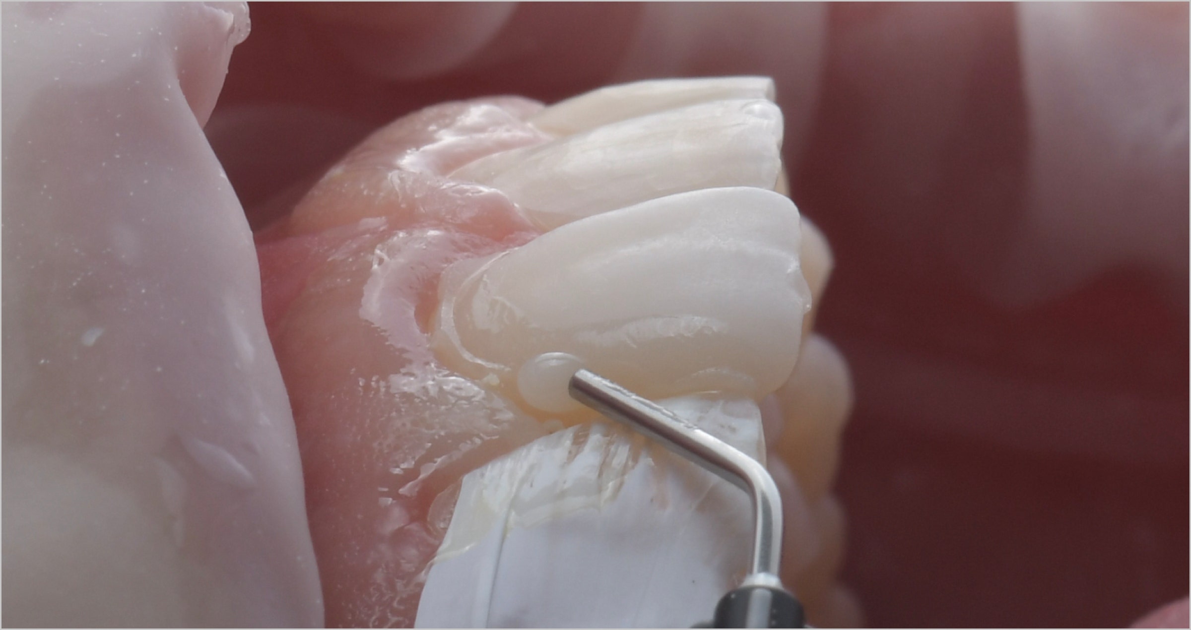 Bonding in minimally invasive repair procedures: tips and tricks