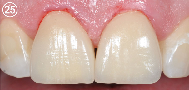 CC 25